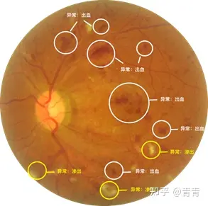 眼底照相图片讲解分析图片