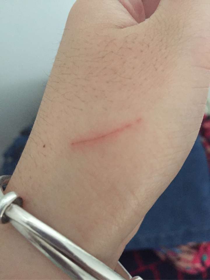 被狗挠伤了咋办?