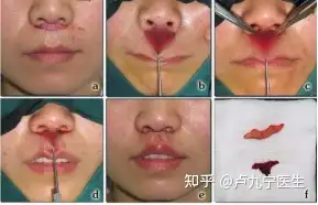 做人中缩短术上嘴唇会变厚变凸嘴吗