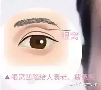 眼下垂眼窩深眼窩凹陷了怎麼辦了