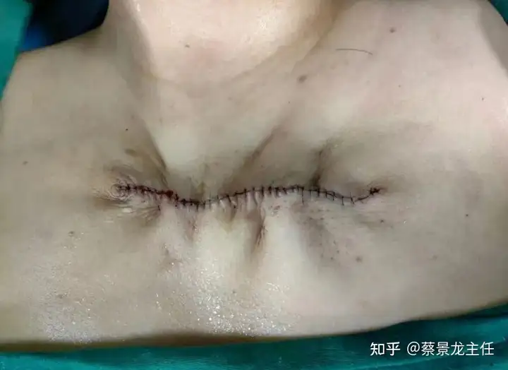 瘢痕疙瘩手术会留更大疤吗?一文读懂关键答案 瘢痕疙瘩手术会留更大疤吗?一文读懂关键答案