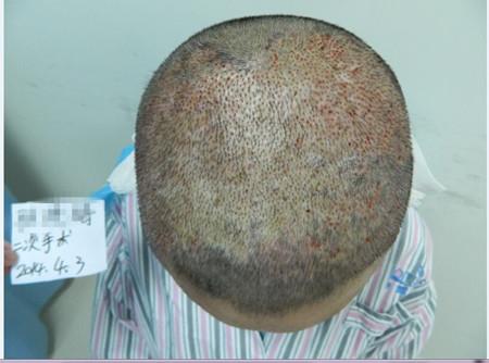 头发移植手术是否对大脑有伤害?