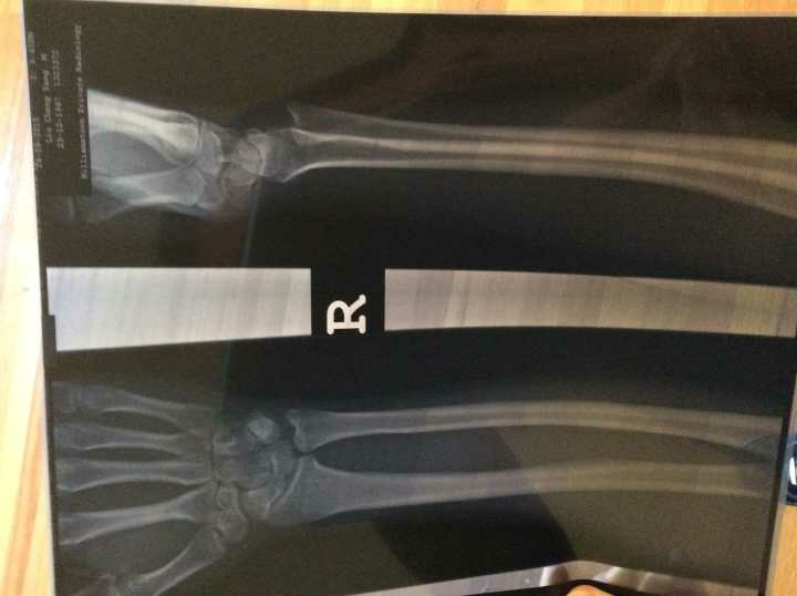 请问一下 手腕之前举哑铃没拿住 被砸了一下 现