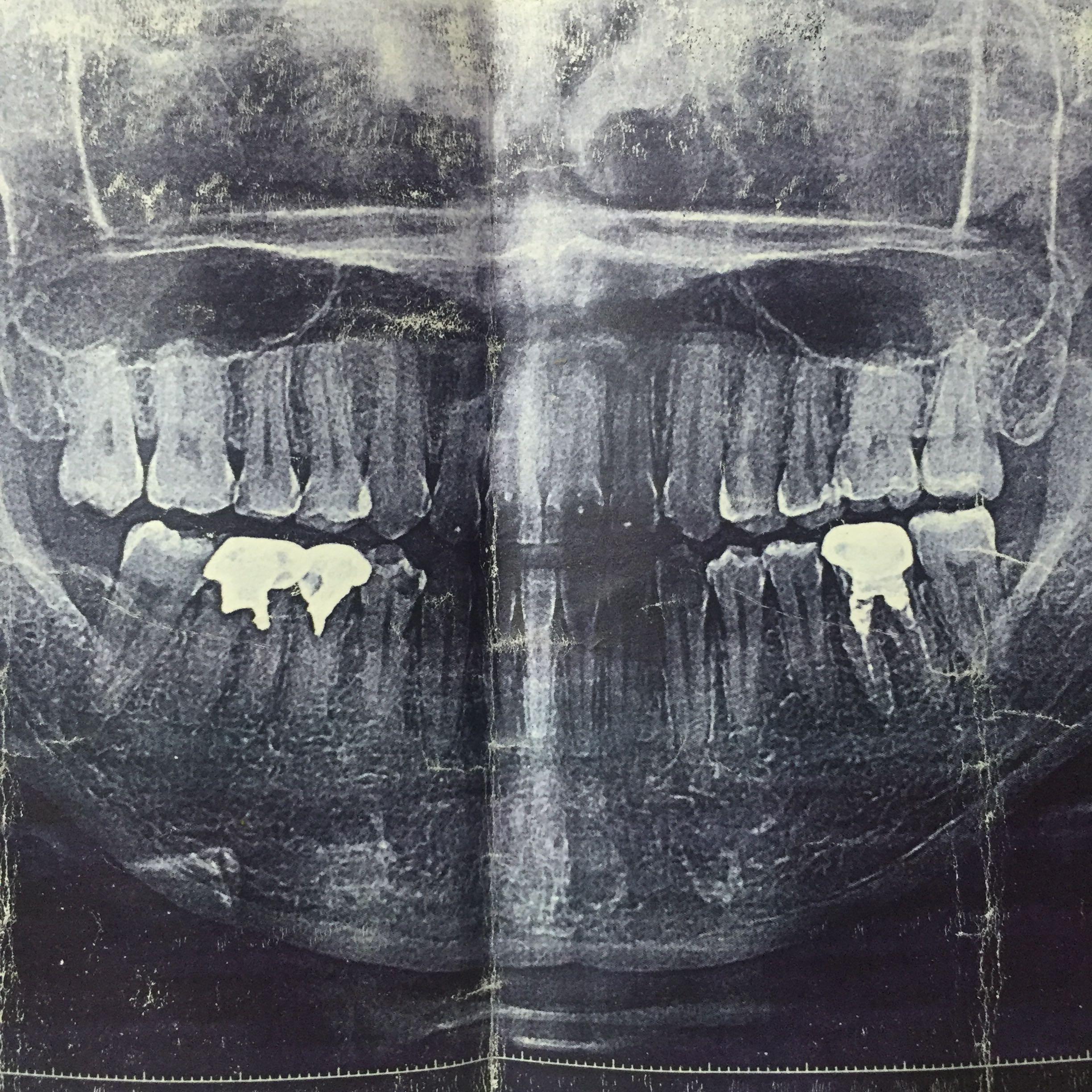 这种情况是不是骨性偏颌,可以正畸吗?