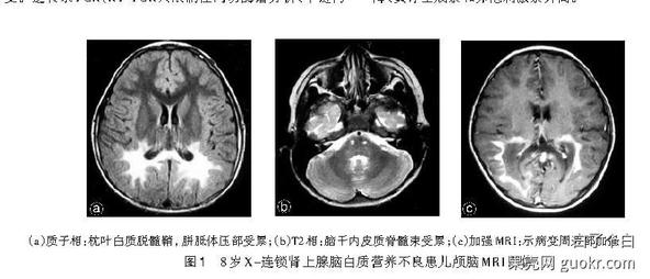 肾上腺脑白质营养不良(adrenoleukodystrophy,ald,amn)