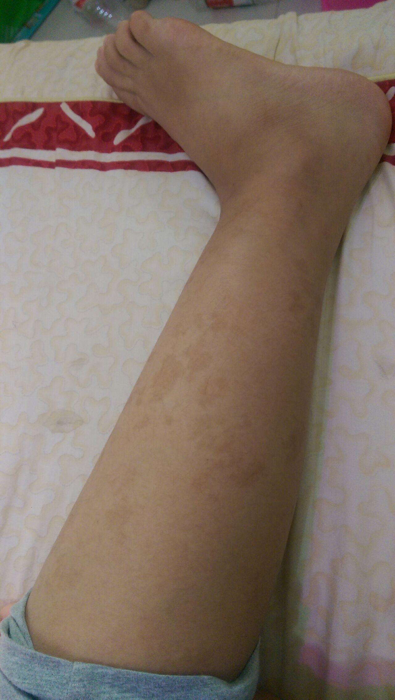 请问小腿上长了这种斑是怎么会事