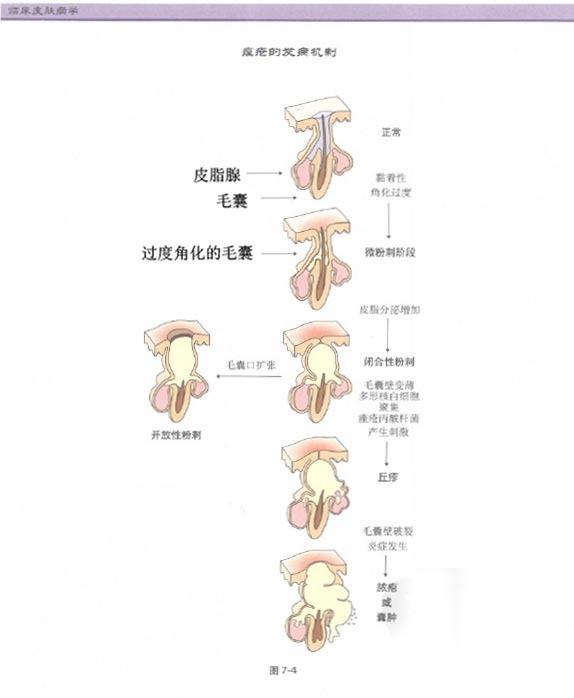 二,元兇:毛囊角化異常