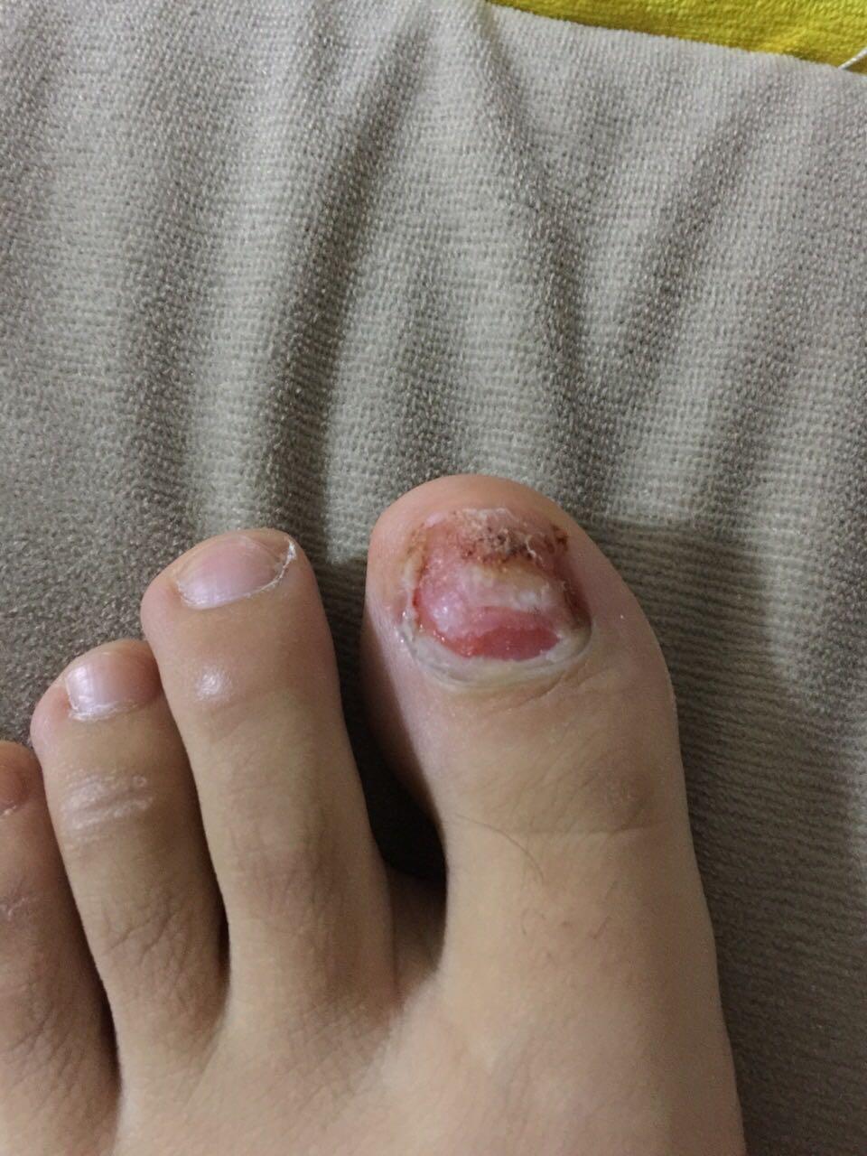 我想知道谁跟我有拔掉脚指甲盖的经历以及怎么保护它