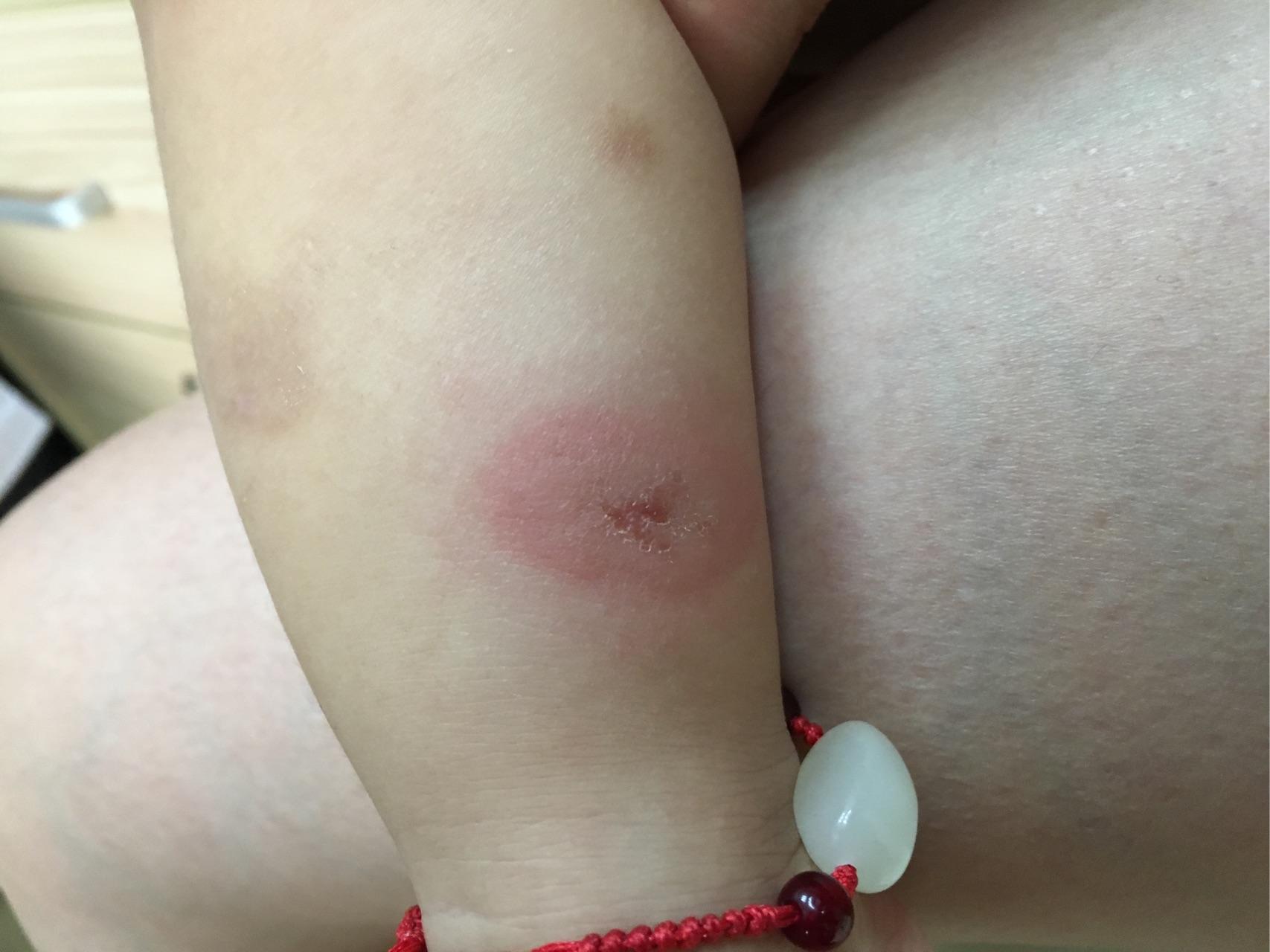 宝宝腿上起一个大包很硬有人知道吗