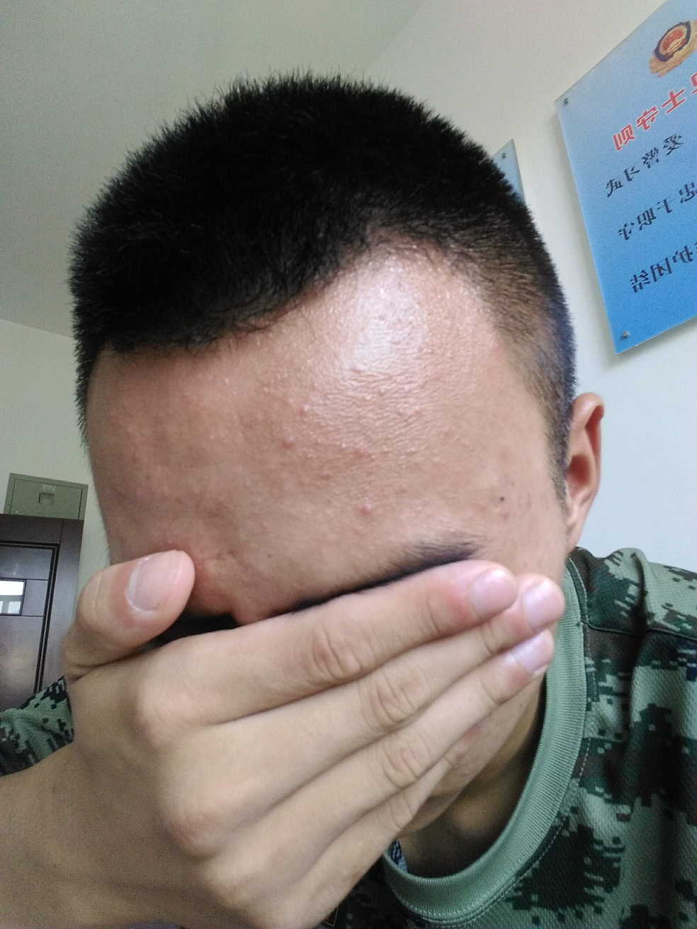 突然脸上额头上就爆了好多痘痘,有的是闭合性