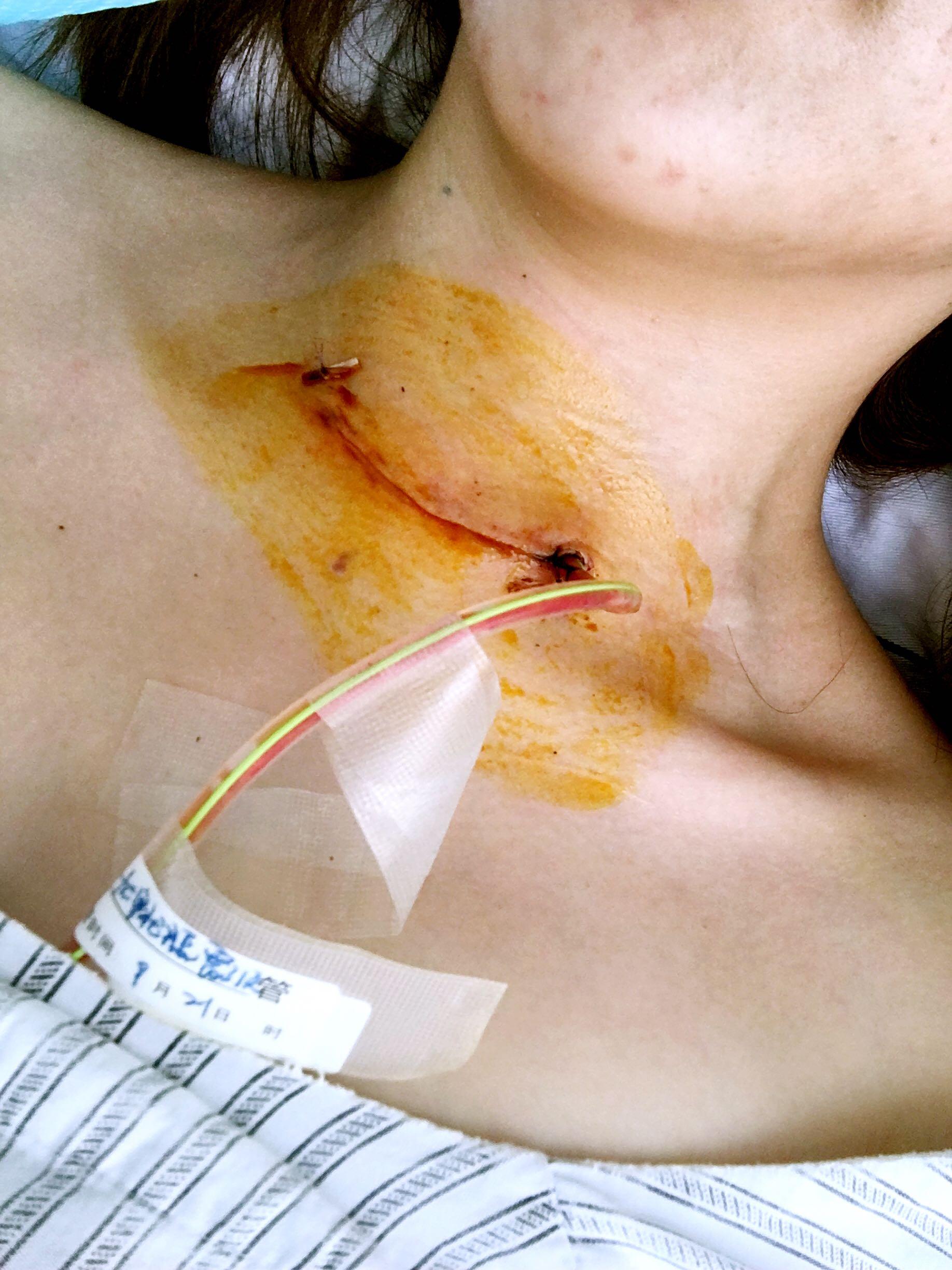 甲状腺手术伤口增生图图片