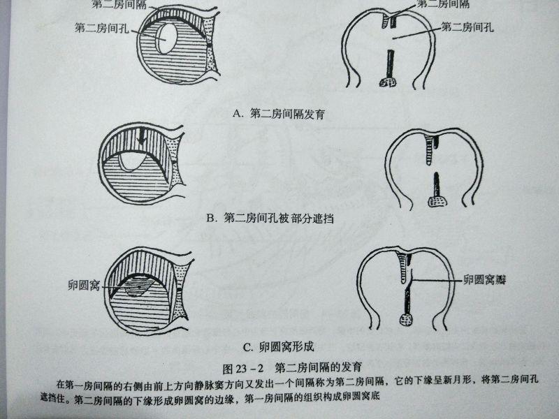 教你读心脏彩超之房间隔缺损 - 知乎