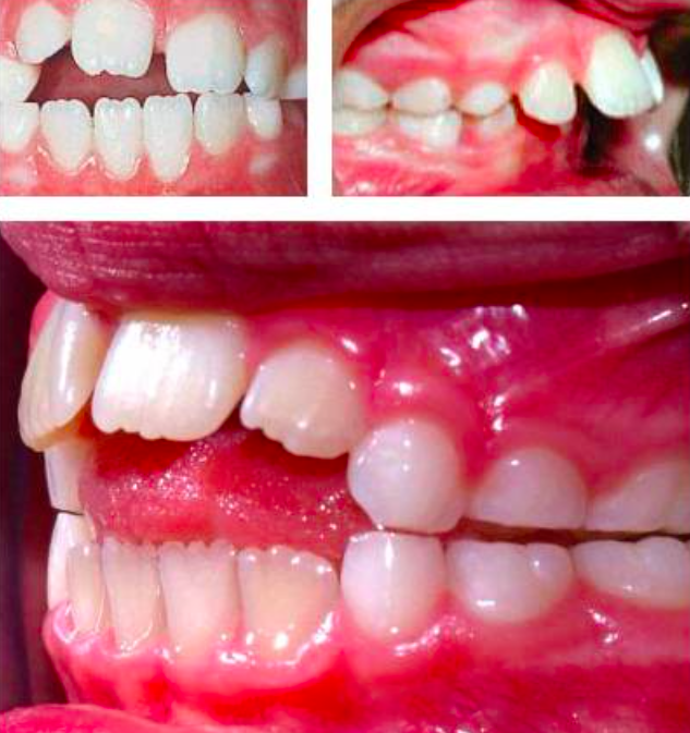 除了视频中介绍的口呼吸之外,口呼吸会让孩子变丑http://v.qq.