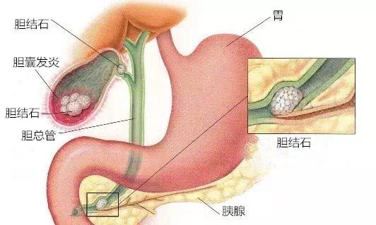 肝内胆管结石位置图片