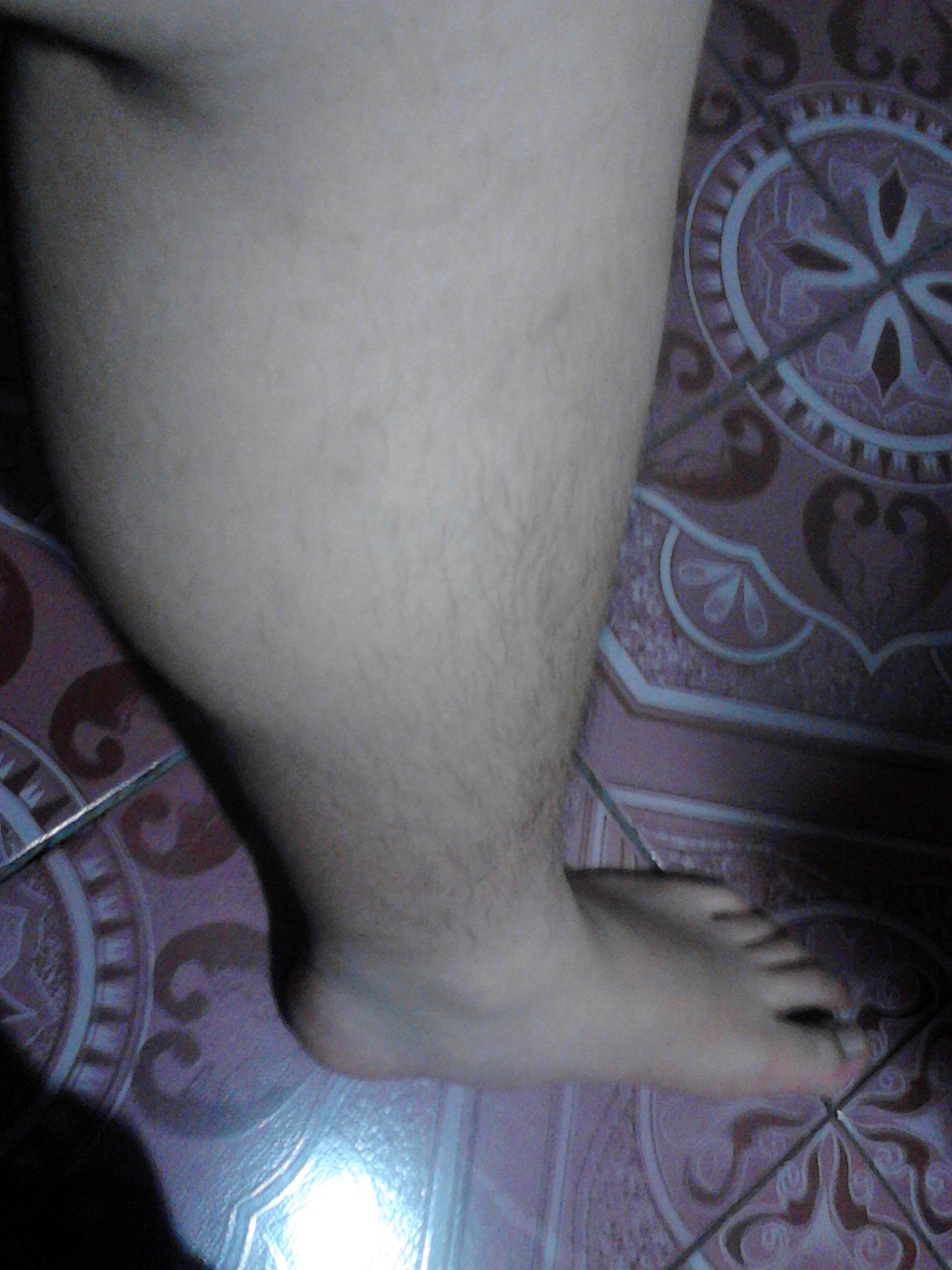 一条腿粗一条腿细(很明显)做些什么锻炼来改善