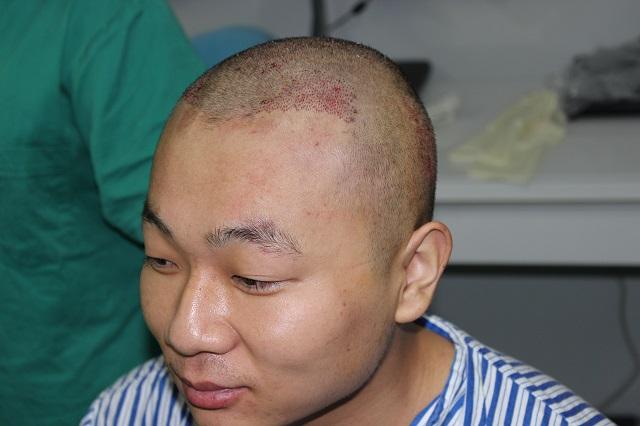为什么秃顶的人这么多很少有做植发的?