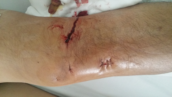 你在踢足球的时候受过最重的伤是什么?