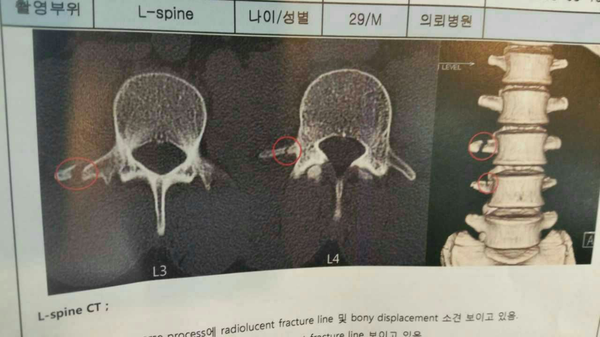 骨折康复 腰椎横突骨折 治疗和康复需要注意什么 知乎