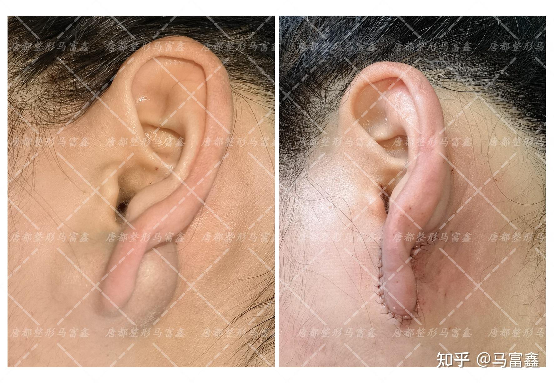 耳垂皮脂腺囊肿:小疙瘩大麻烦