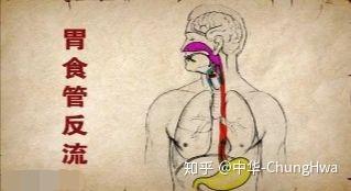 梅核气 | 是什么东东?你会有吗? - 知乎