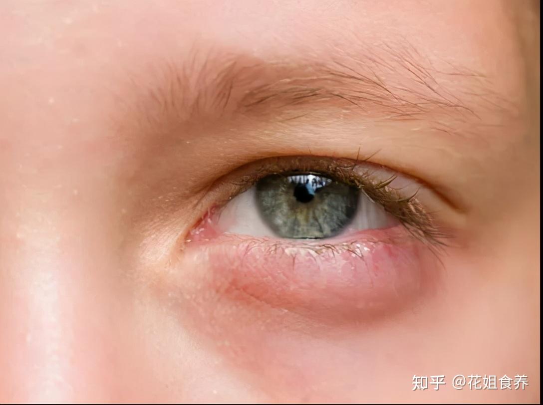 水肿型眼袋的辨别的方法很简单:看起来眼睛比较浮肿,如果前一天晚上