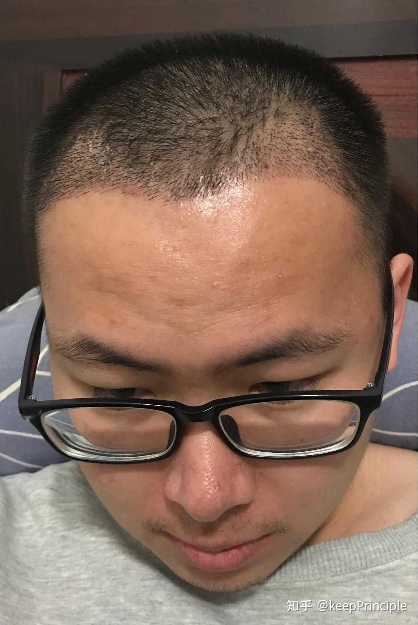 植发1个礼拜(植发一周后多久洗一次头发)