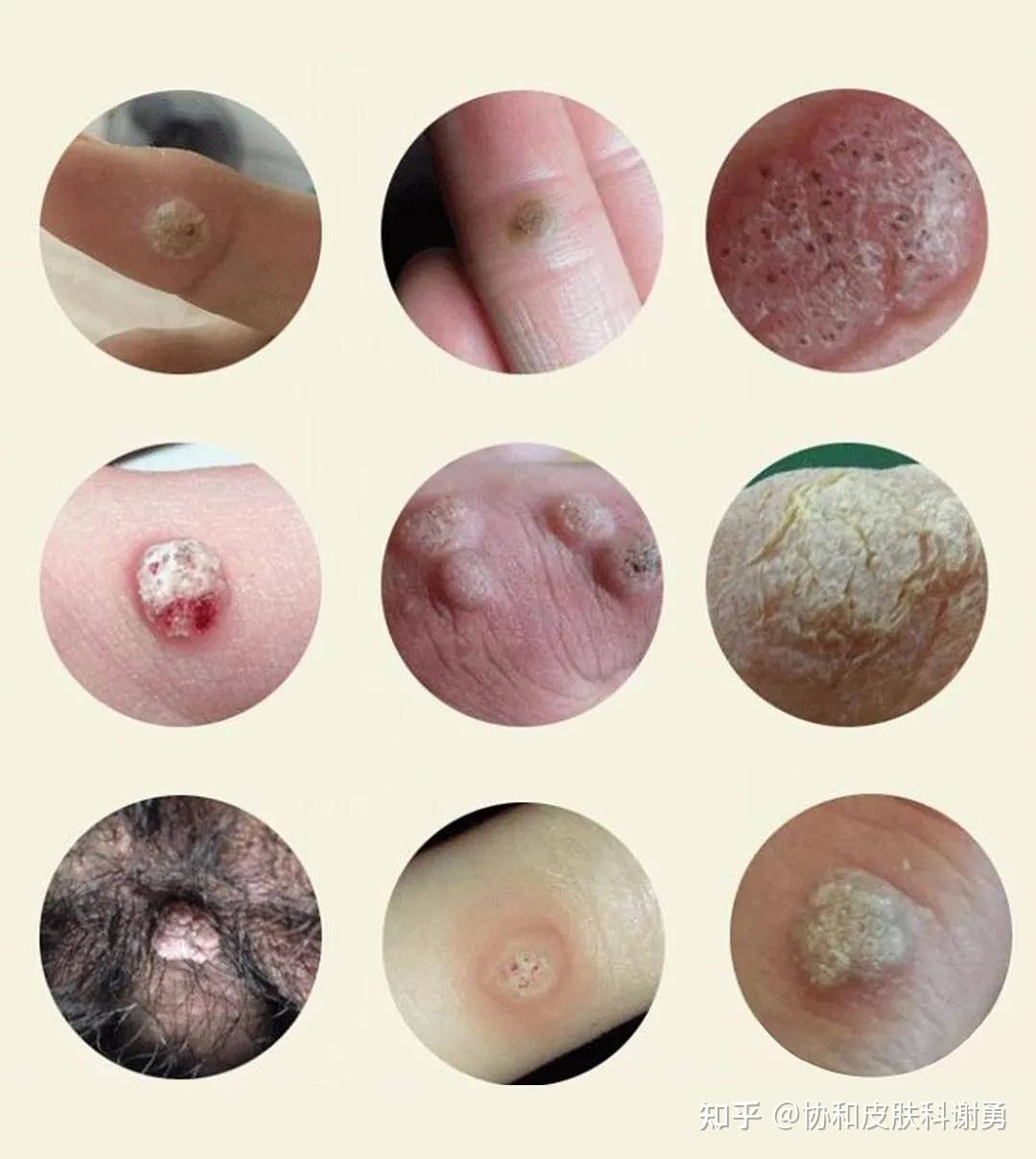 男性得尖锐湿疣有哪些表现