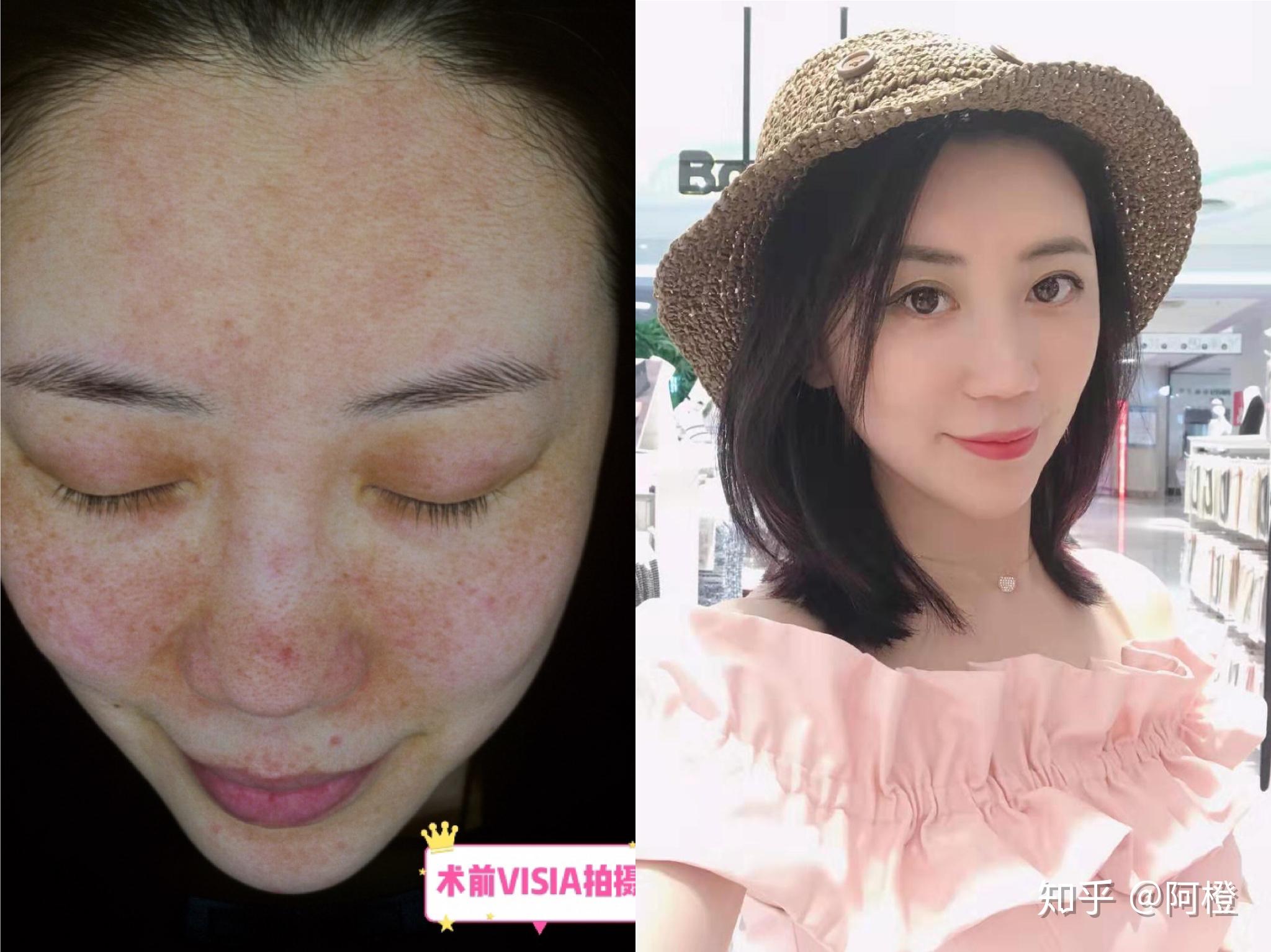 激光祛红血丝到底靠谱吗