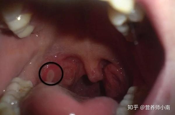 咽喉里长溃疡 怎么做才能有效治愈 知乎