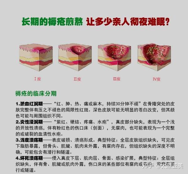 【科普】压疮(褥疮)重在预防,请记住这些做法! - 知乎