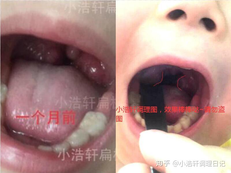 展示一下最近给孩子调理扁桃体肿大的战果以及最近的一些操作