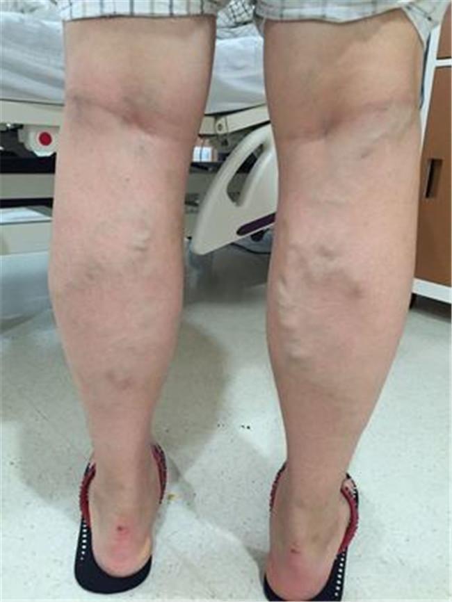 下肢静脉曲张皮肤瘙痒怎么办