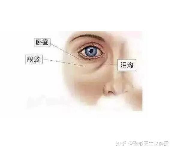 泪沟长什么样子?有泪沟该怎么办? - 知乎