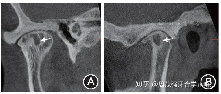 图德咬合学文献科普指南与共识颞下颌关节紊乱病ct检查规范及诊断标准