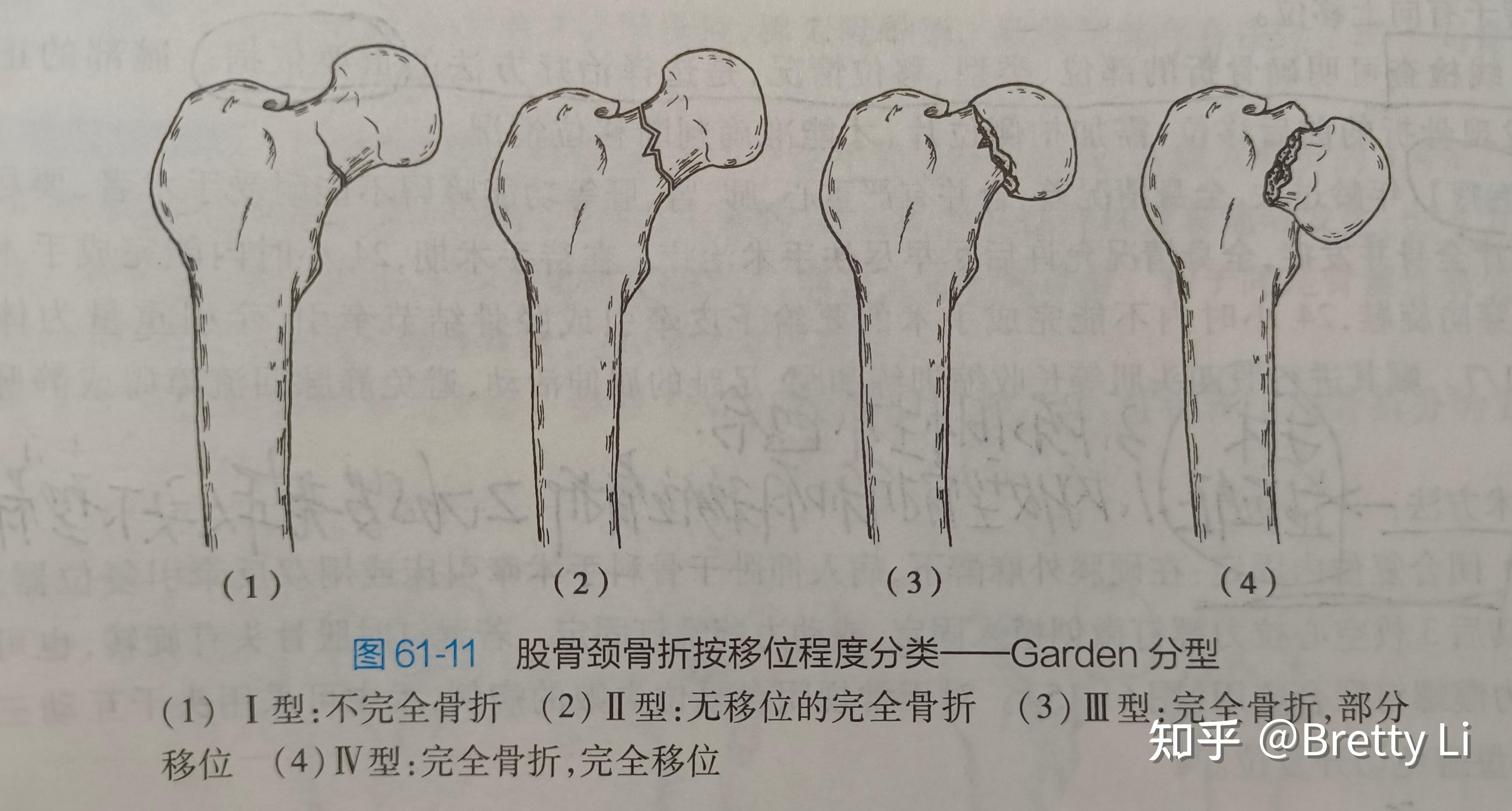 常见骨折类型X线片探讨分析2 知乎