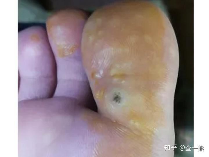 蹠疣篇少女脫疣重生玉腳的15天經歷