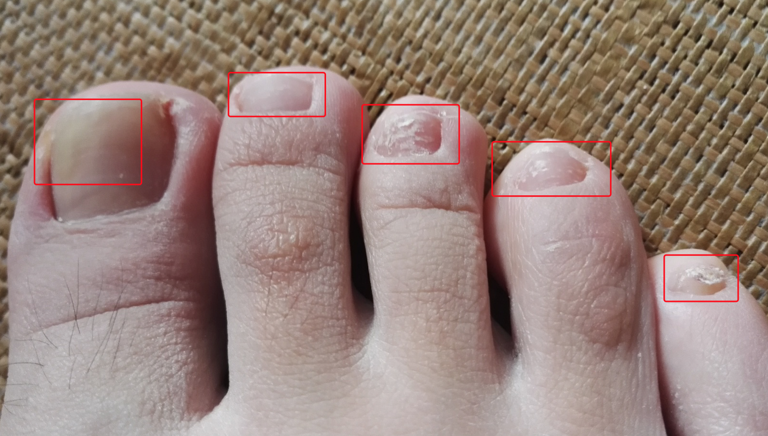 谢邀,根据症状图片判断,是属于真菌感染引起的灰指甲,症状表现为甲