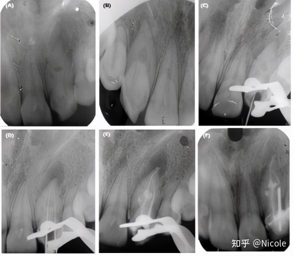 上颌侧切牙中的根管钙化与牙齿畸形