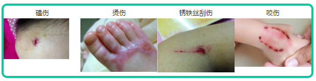 一针破伤风1岁娃躺进急救室!孩子磕破头、被人咬到底该不该打针? - 知乎