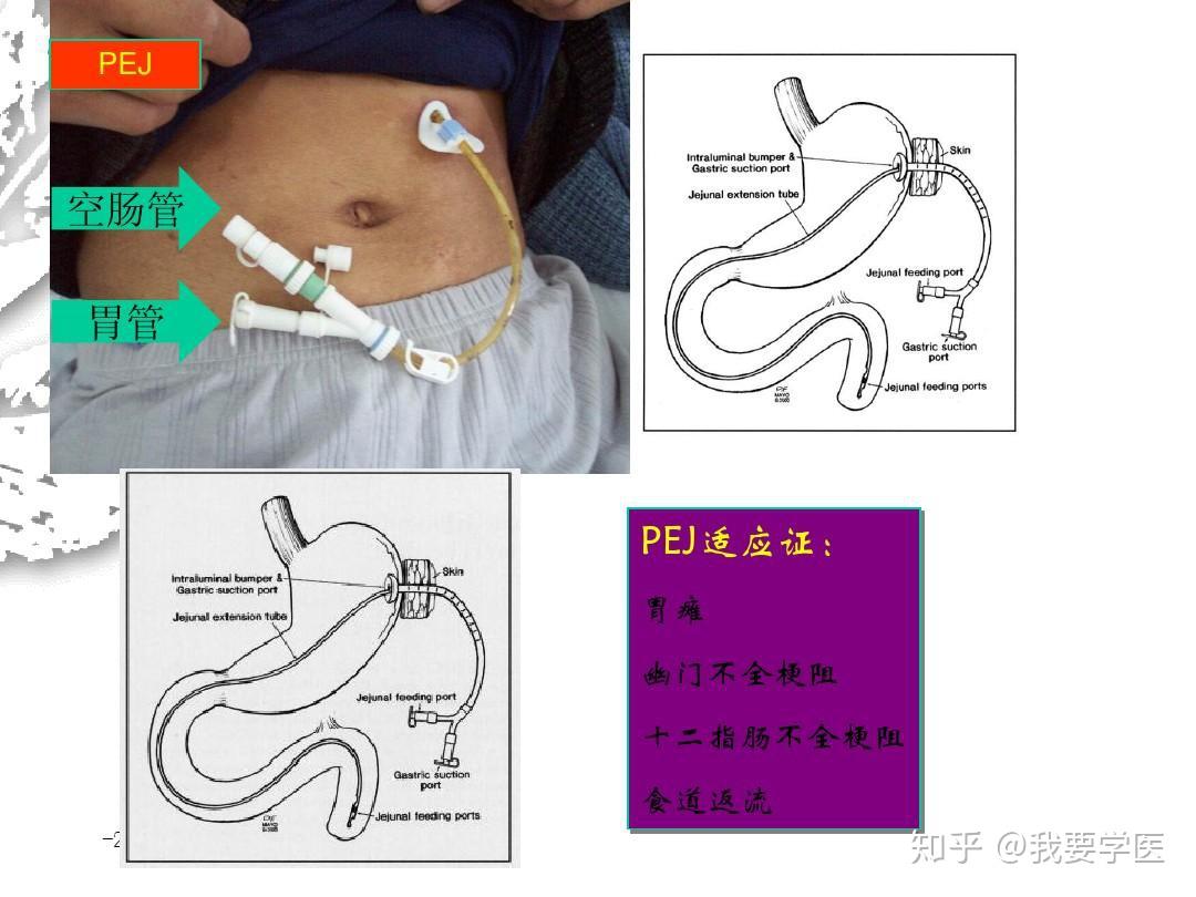 胃空肠造瘘管护理要点 - 知乎