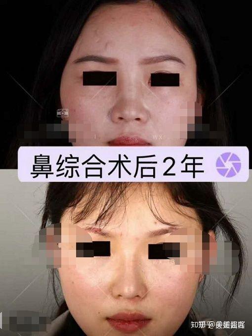 隆鼻干货 如何选择适合自己的鼻型 全国热门隆鼻医生测评 附案例 知乎