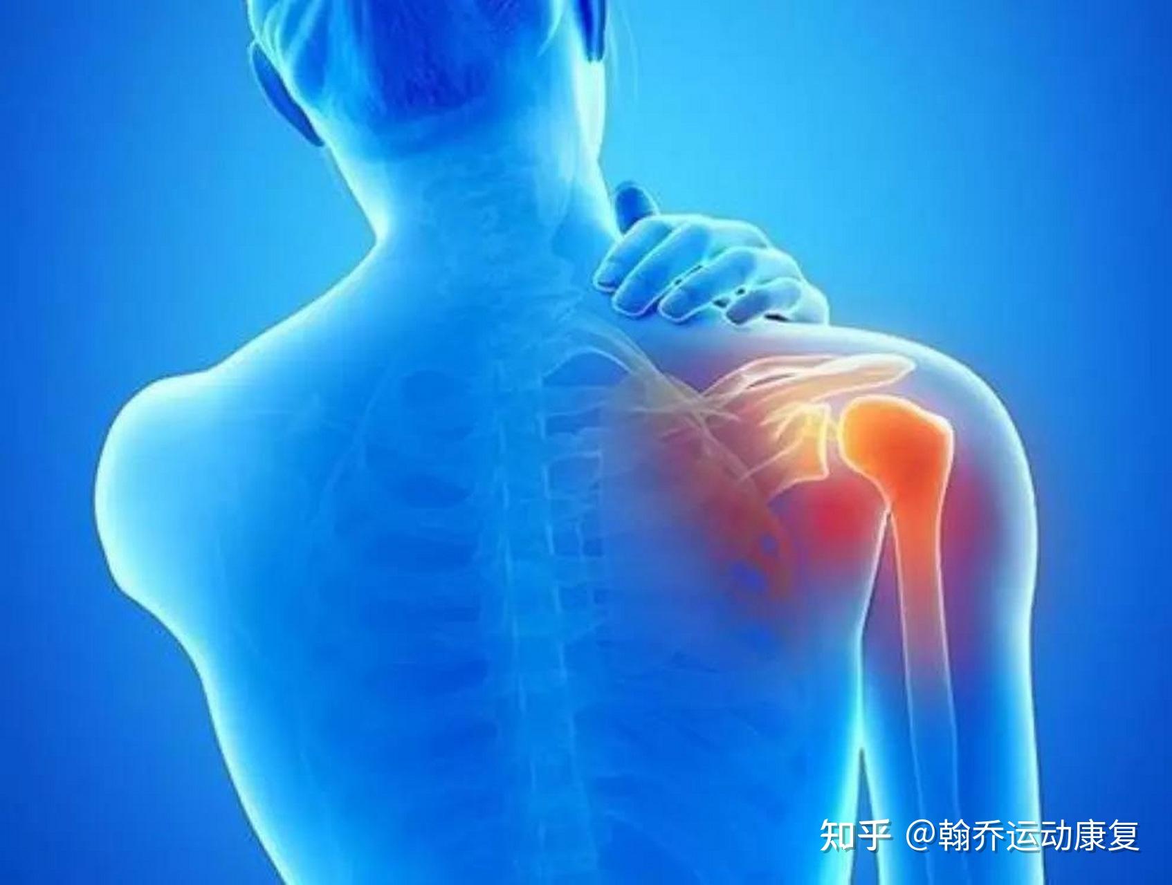 【卫生社团】疼起来能要命的肩膀疼，你以为是肩周炎，其实是......|肩周炎|社团|肩膀|关节|患者|撕裂|疾病|-健康界