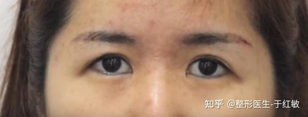 眼尾下垂能通过去皮矫正吗 知乎