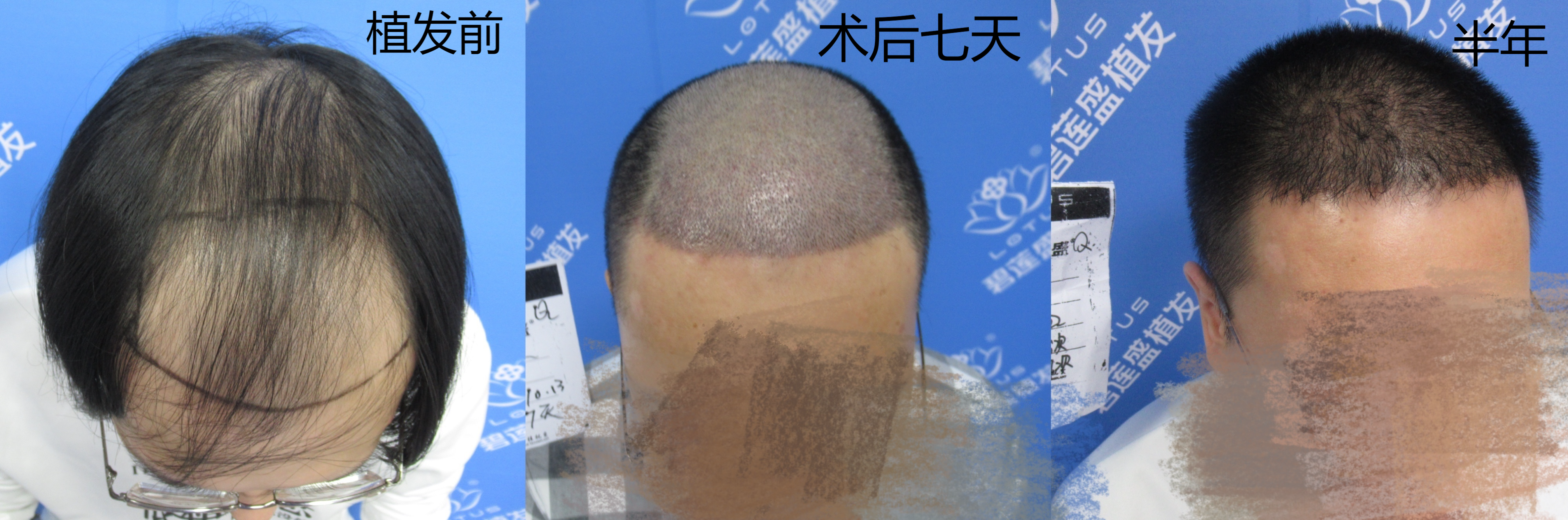植发都是植哪里的毛囊呢(植发都是植哪里的毛囊呢图片)