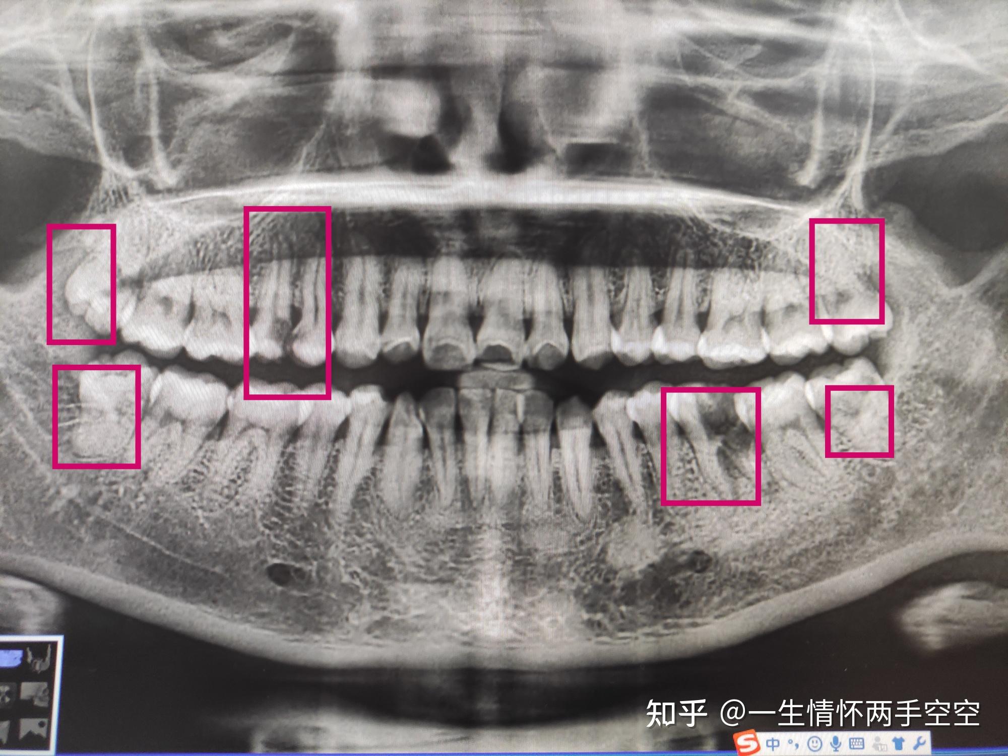 上下,左右各一顆智齒,上面兩顆智齒已經齲了,建議拔除2:上 右4號牙和5