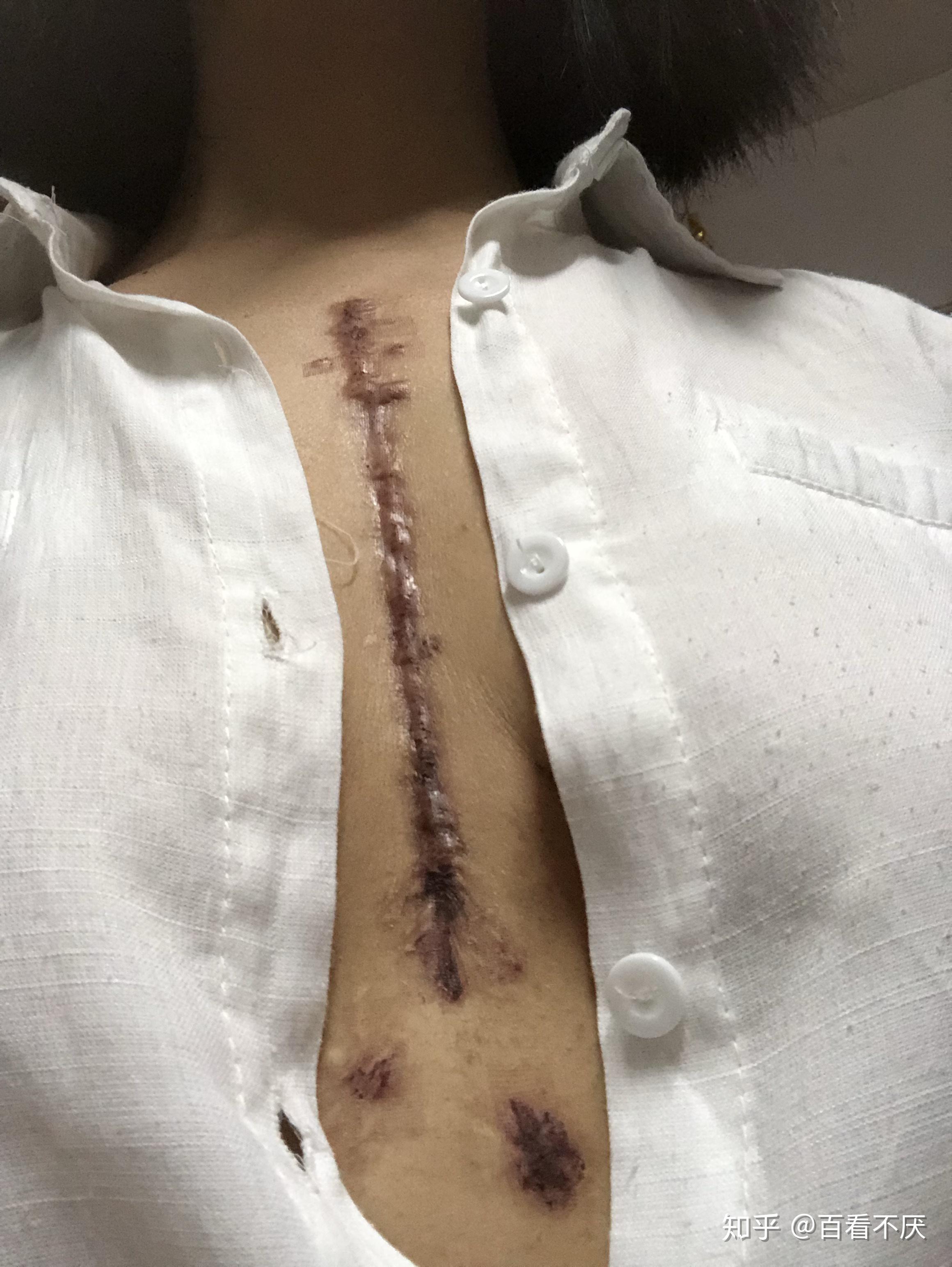 第4天第1天  20191121 点阵激光后 疤痕红肿手术前2017年开胸手术后