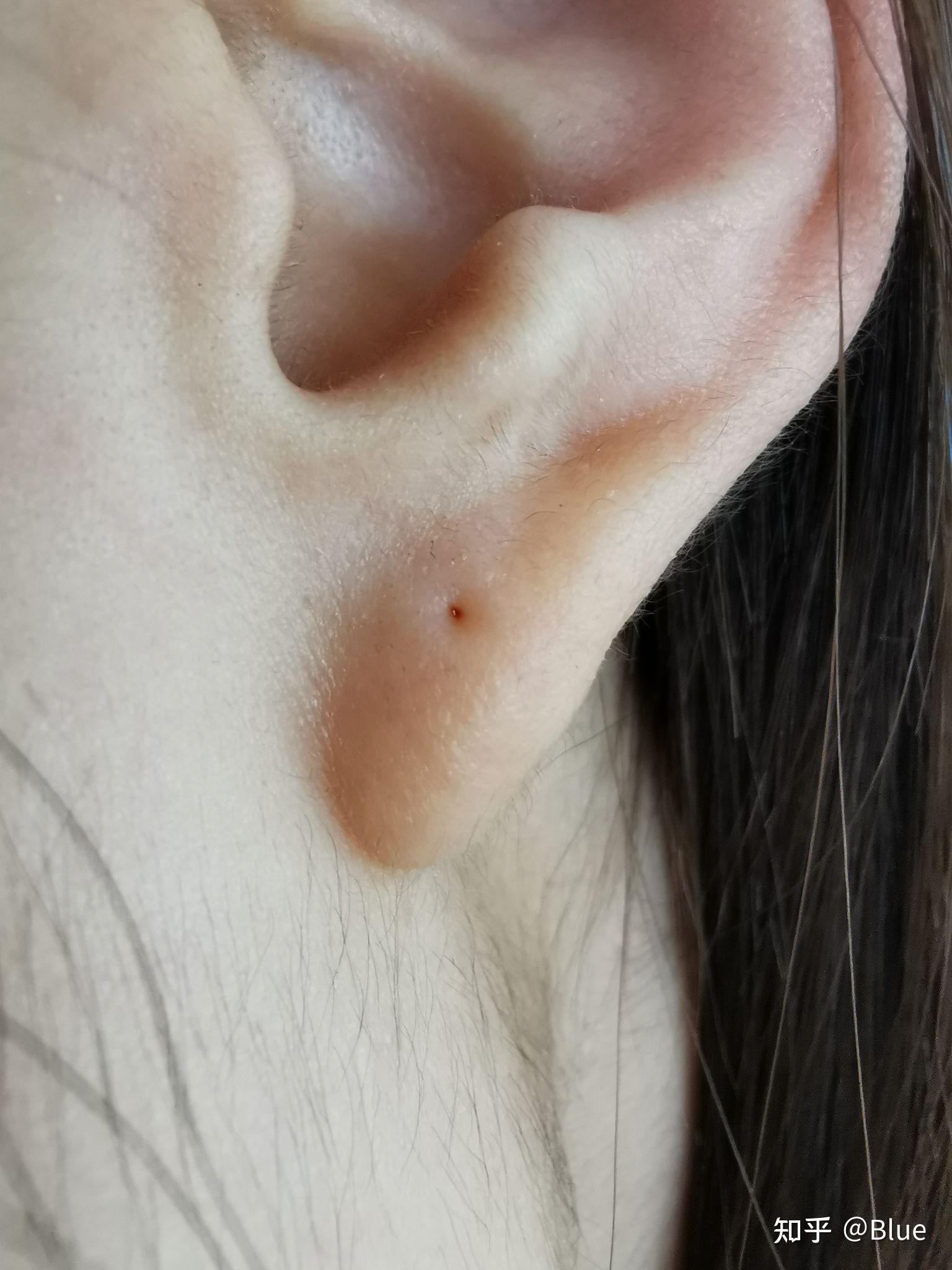 耳洞发炎红肿化脓艰辛恢复历程 