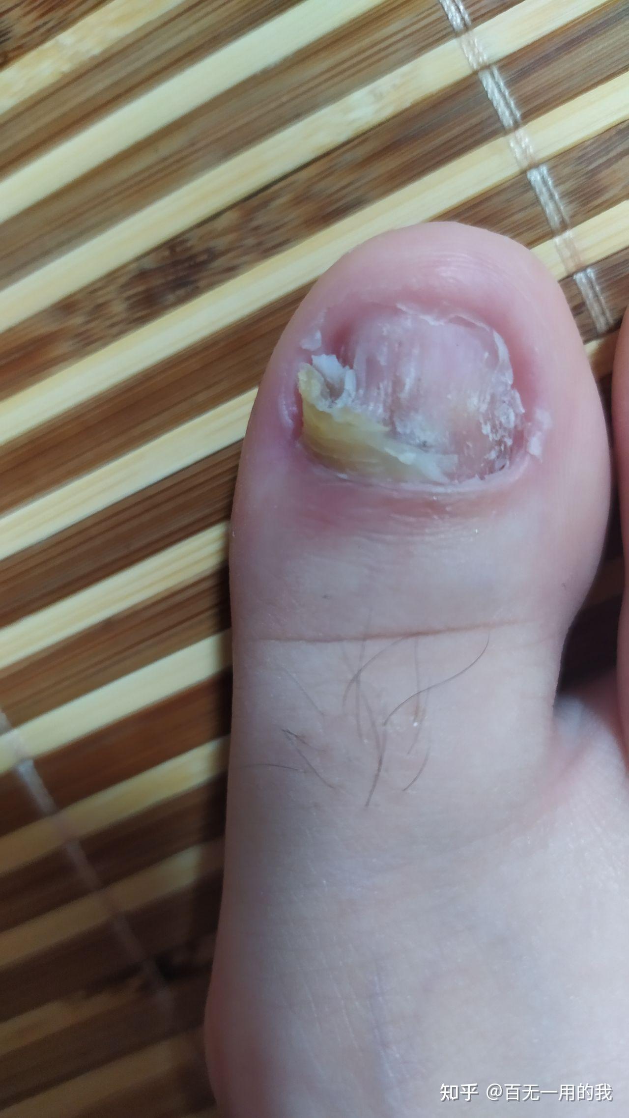 灰指甲初期脚趾头图片