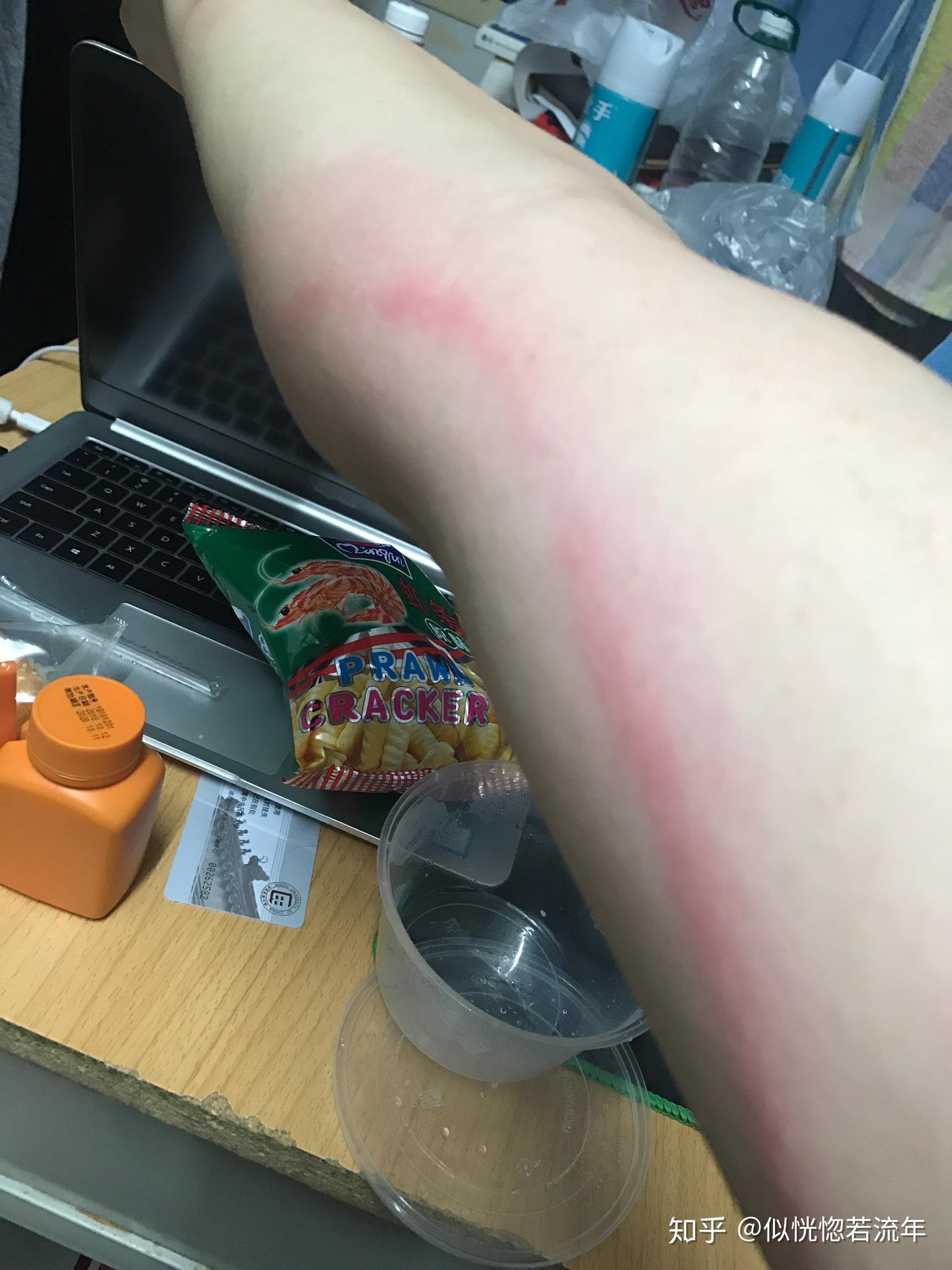 被虫子咬了,胳膊上一条红线往上延伸,这是什么? - 知乎