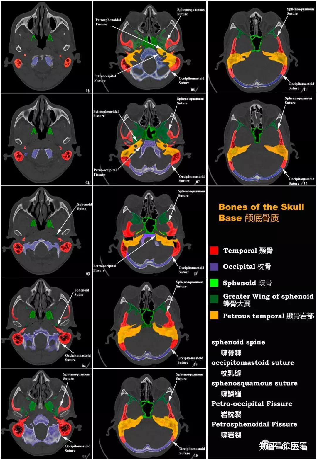 顱底顱骨ct高清圖解